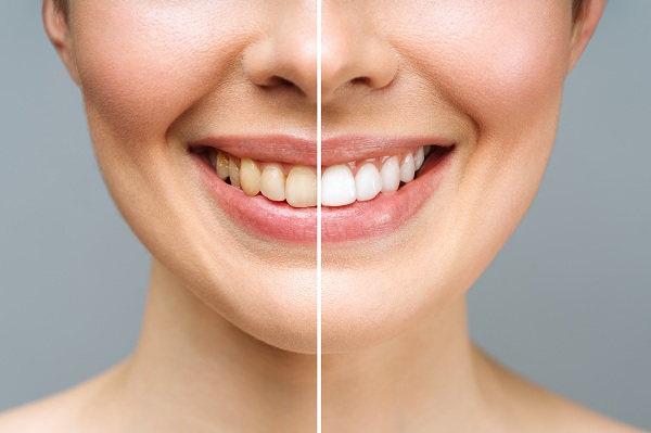 Teeth Whitening Clinic